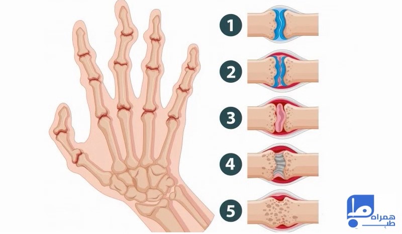 روماتیسم مفصلی 
