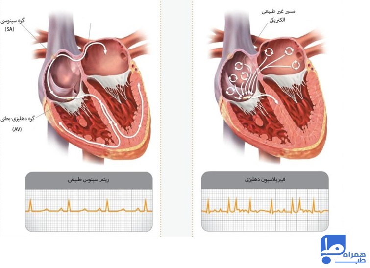 آریتمی قلبی