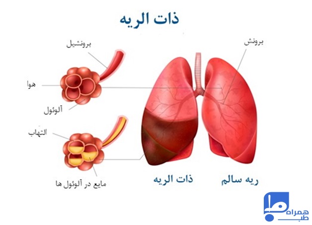 درمان قطعی ذات الریه