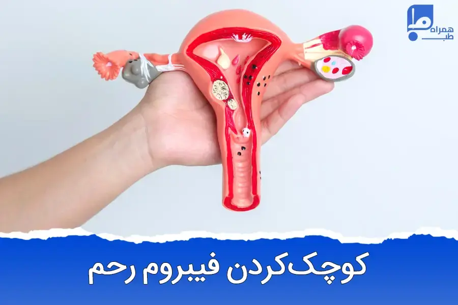 راه کوچک شدن فیبروم