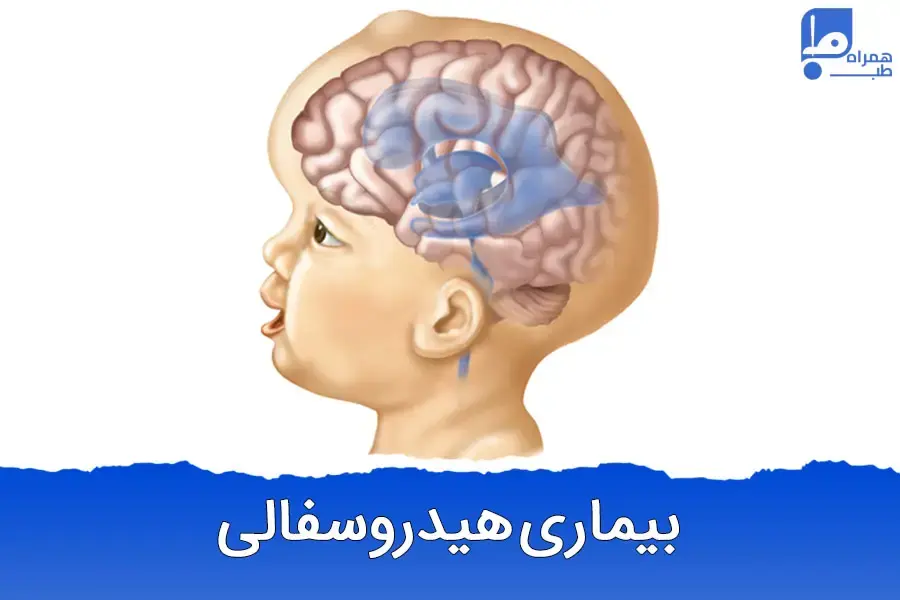 هیدروسفالی