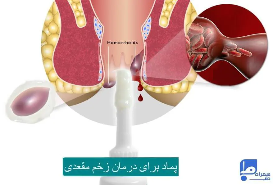 زخم مقعدی 