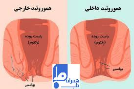 درمان هموروئید 