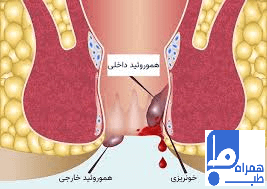 هموروئید