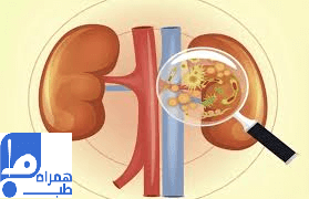 درمان عفونت کلیه 