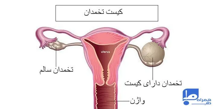 درمان و جراحی کیست تخمدان 