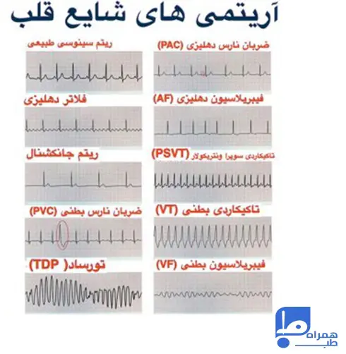 آریتمی قلبی 