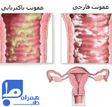 عفونت واژن