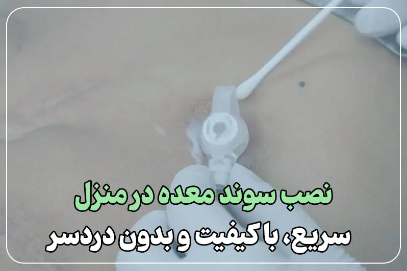 مزایای خدمات سوند معده در منزل