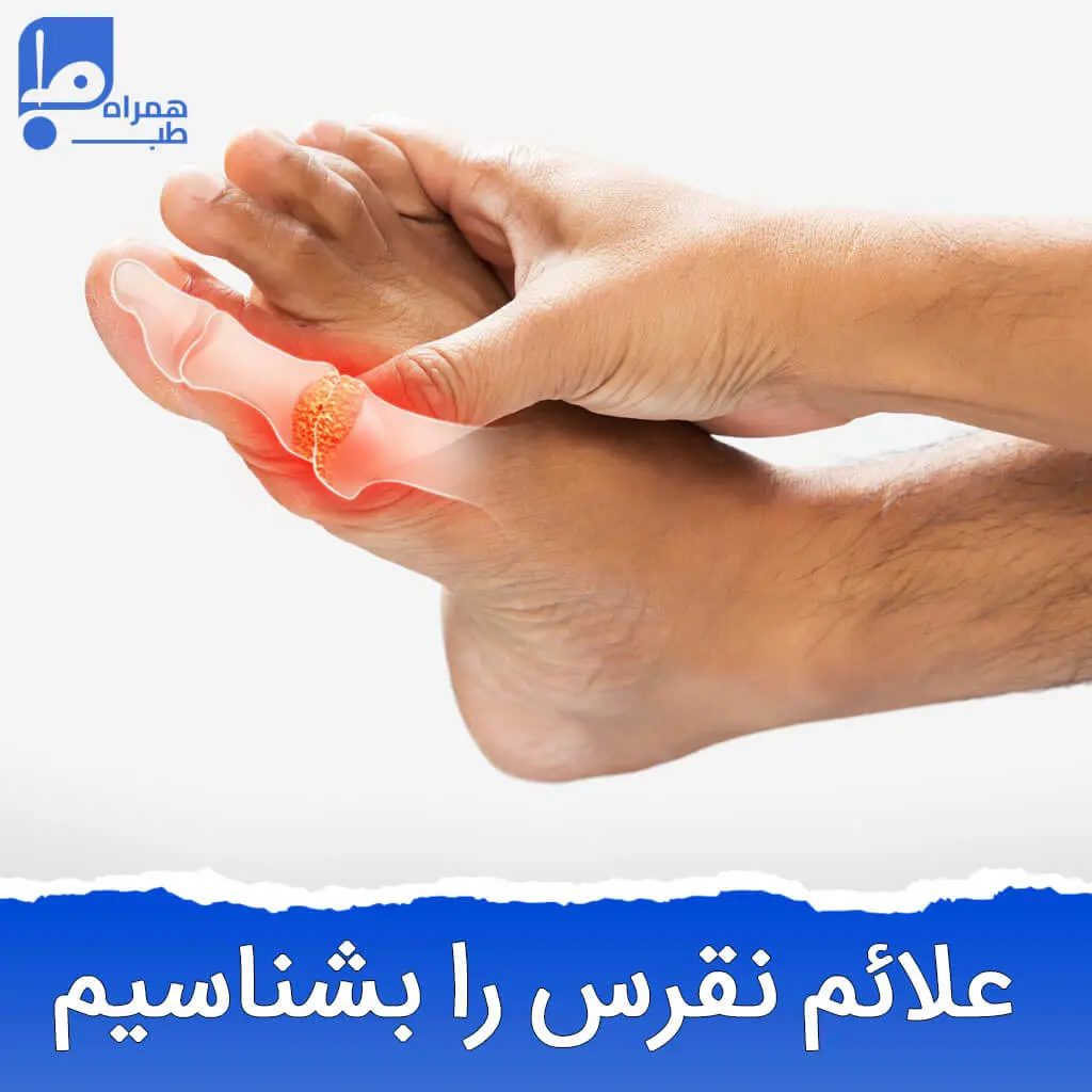 نقرس چیست