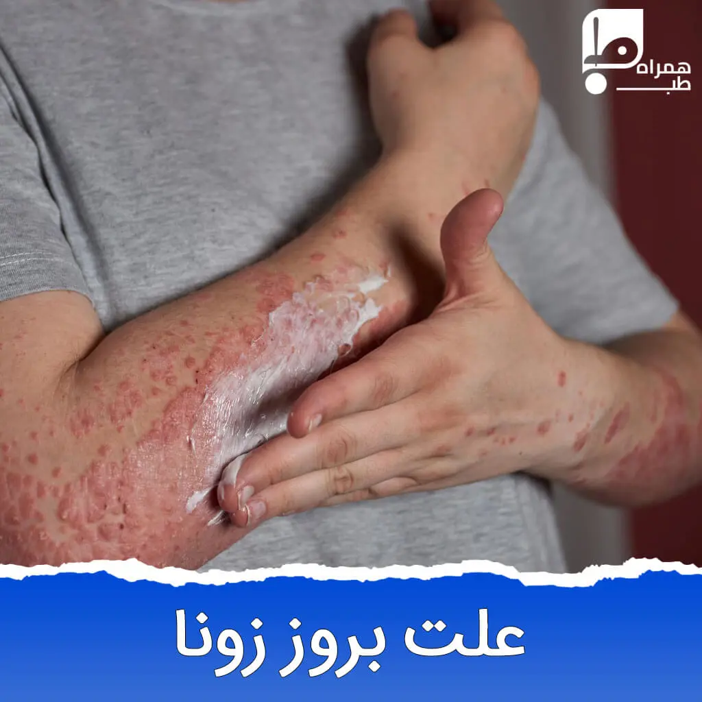عکس بیماری زونا در بزرگسالان 