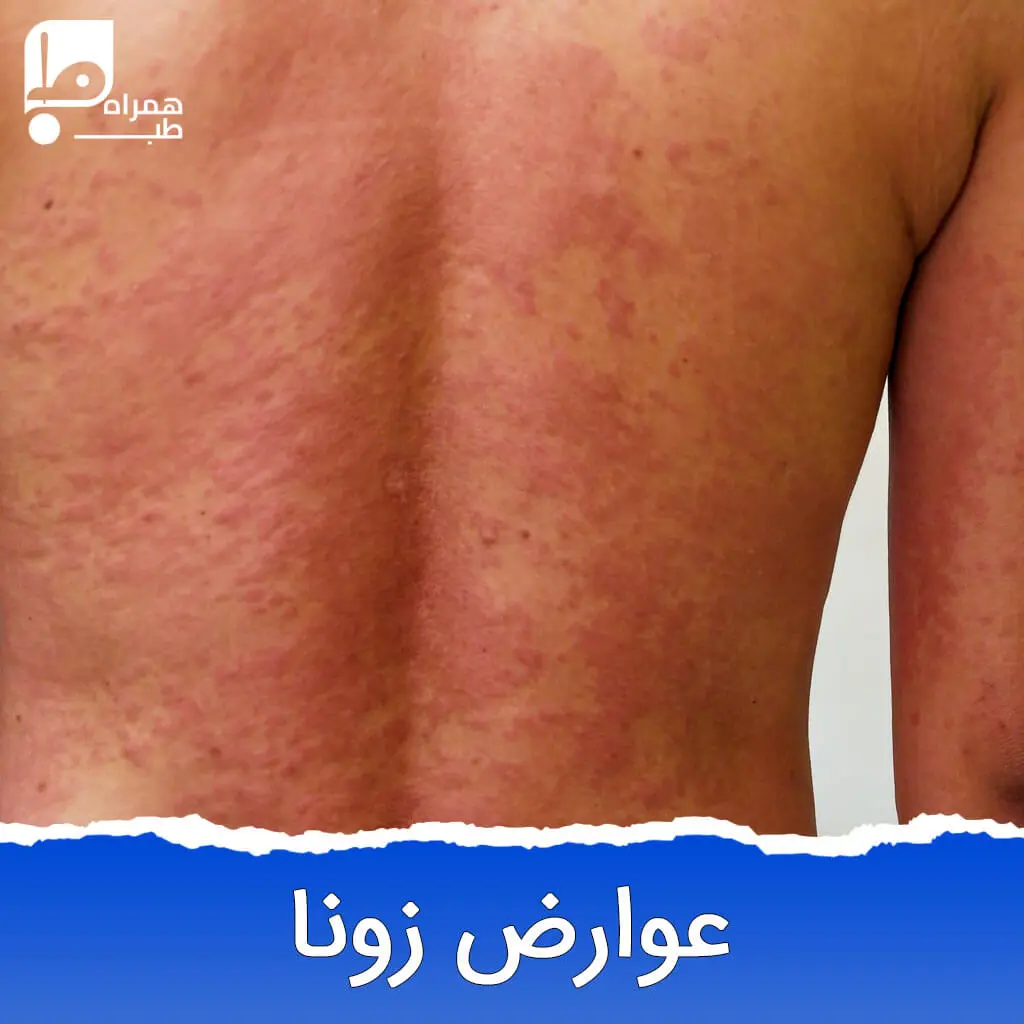 علائم زونا در زنان 
