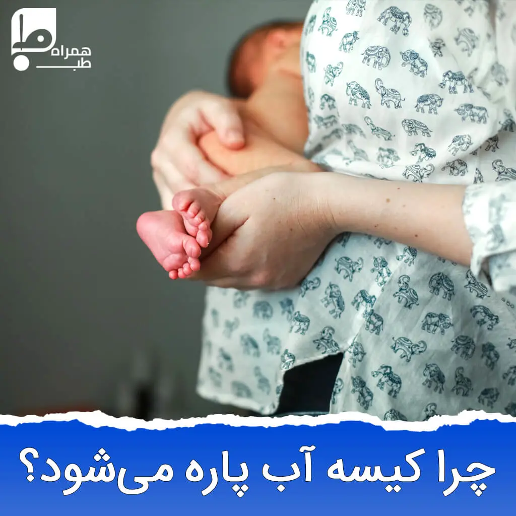 پارگی کیسه آب رحم 