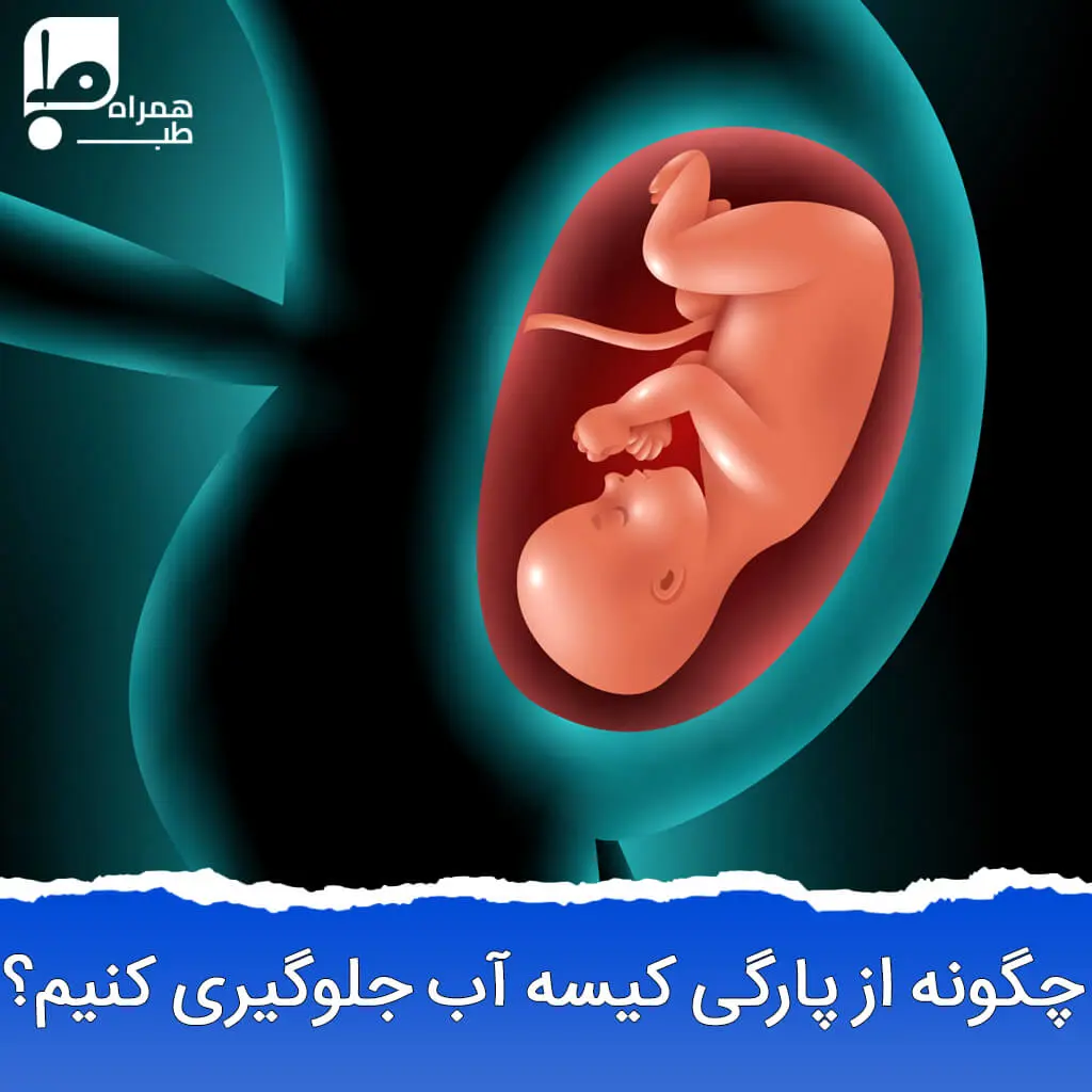 چگونه از پارگی کیسه آب جلوگیری کنیم ؟ 