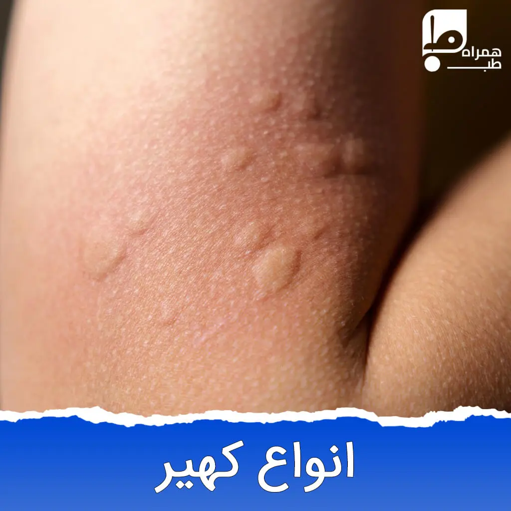 انواع کهیر و درمان آن 