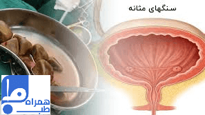 سنگ مثانه 