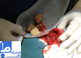 سنگ مثانه چیست 