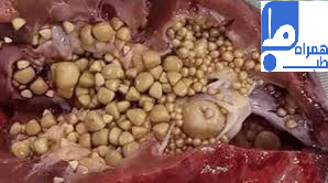 سنگ مثانه 