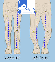 پای پرانتزی 