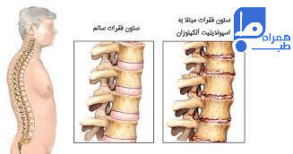 روماتیسم ستون فقرات 