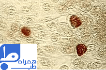 کلامیدیا 