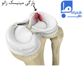 پارگی مینیسک زانو 