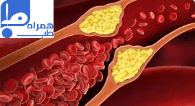 درمان چربی خون بالا 