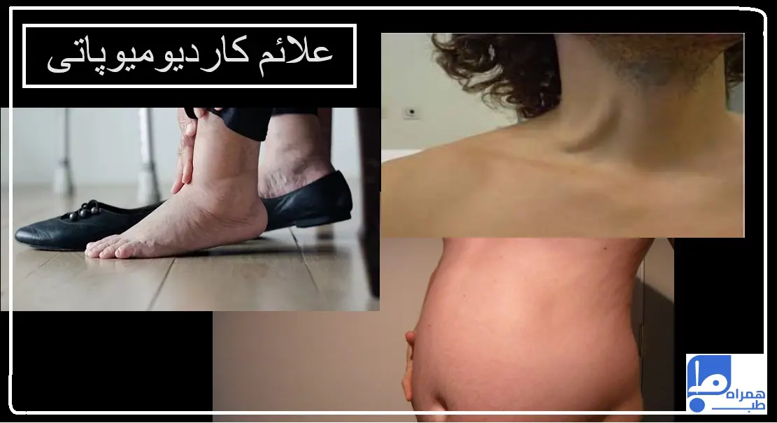 علائم و درمان کاردیومیوپاتی 