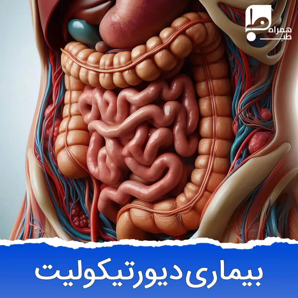 بیماری دیورتیکولیت 