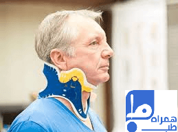 شکستگی گردن 