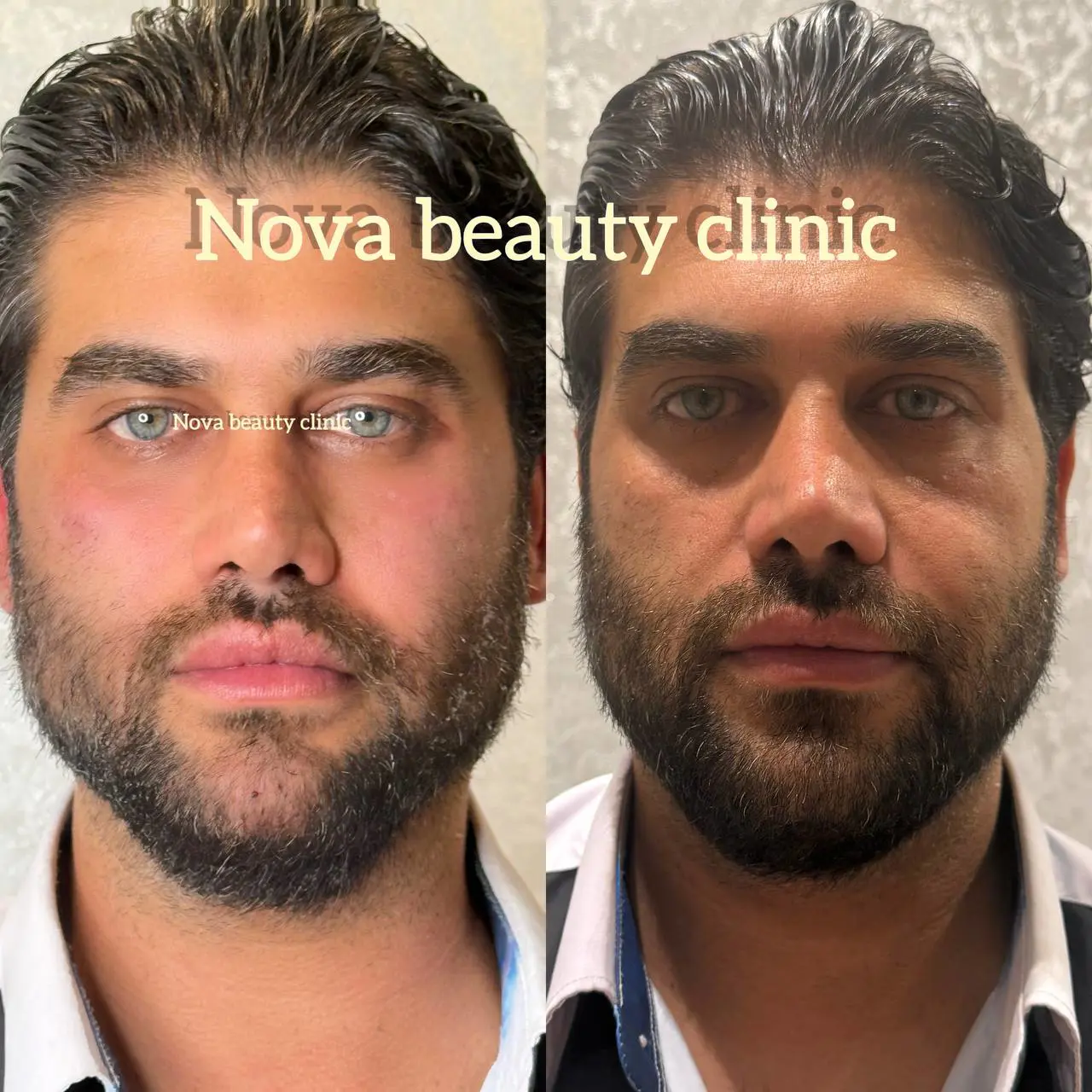 نمونه کار تزریق فیلر در منزل