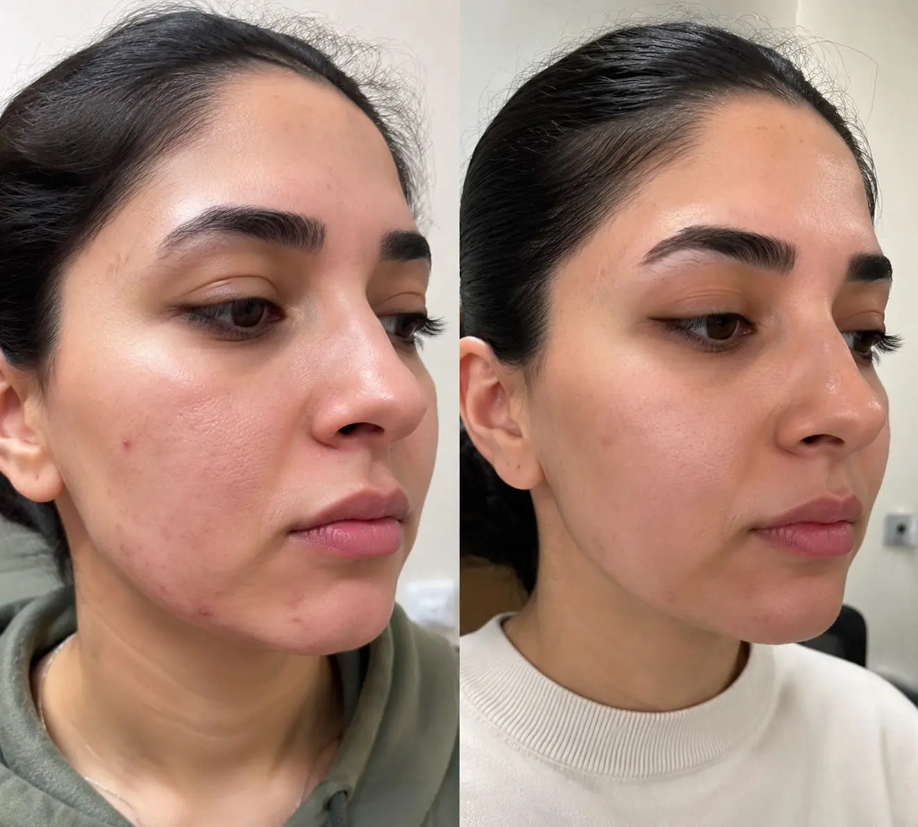 نمونه کار فیشیال صورت